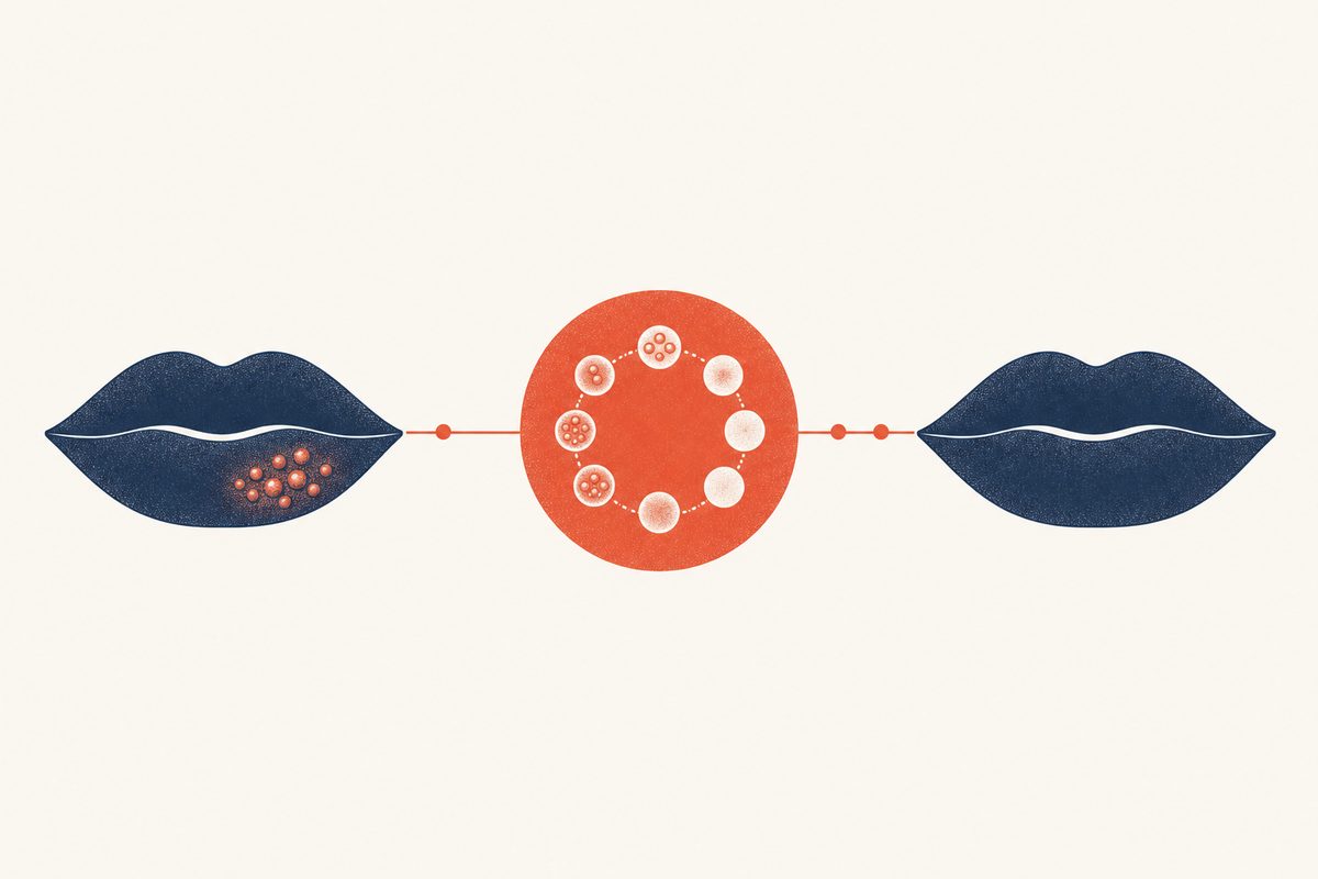 Editorial medical illustration representing the stages of a cold sore outbreak